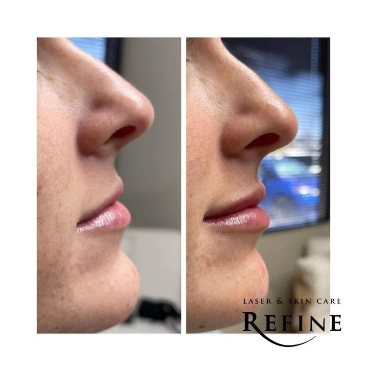 Lip filler before and after, side profile, in Chanhassen, MN