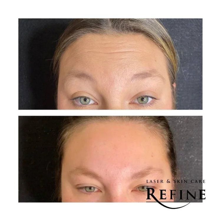 Botox