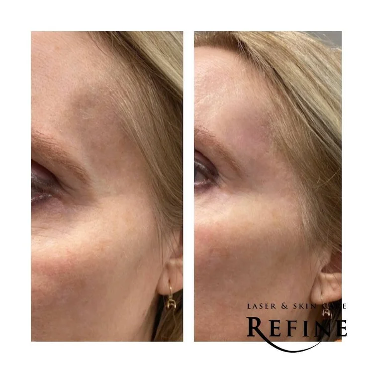 Voluma Dermal Fillers for Temples