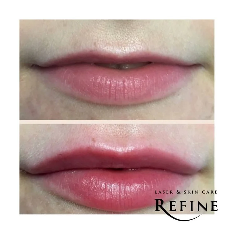Dermal Fillers for Lips with Juvederm Ultra