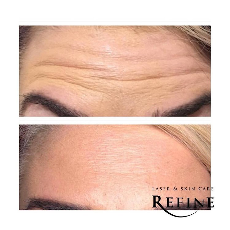 Botox Injections