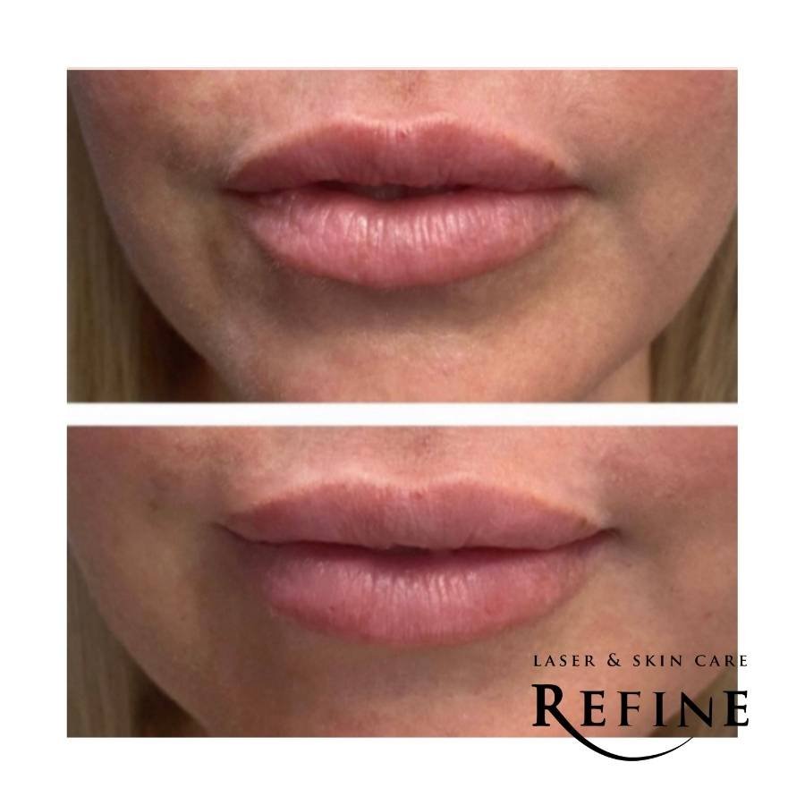 Lip Fillers with Juvederm Ultra