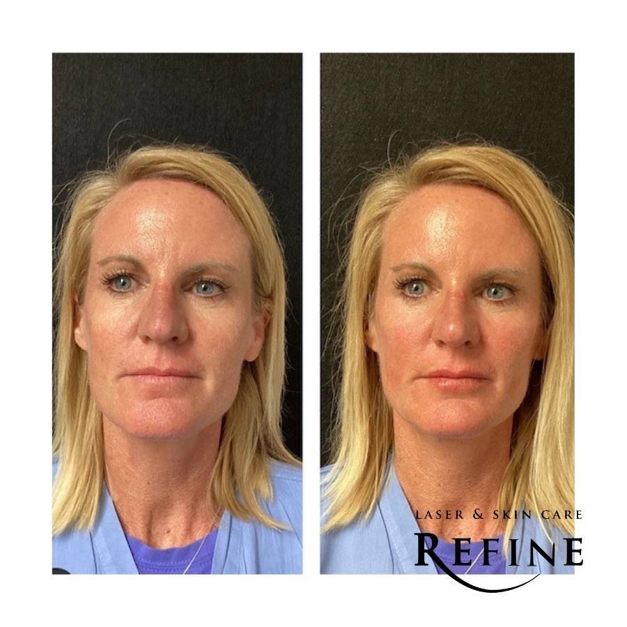 Full Face Rejuvenation using 3 syringes from the  RHA  collection