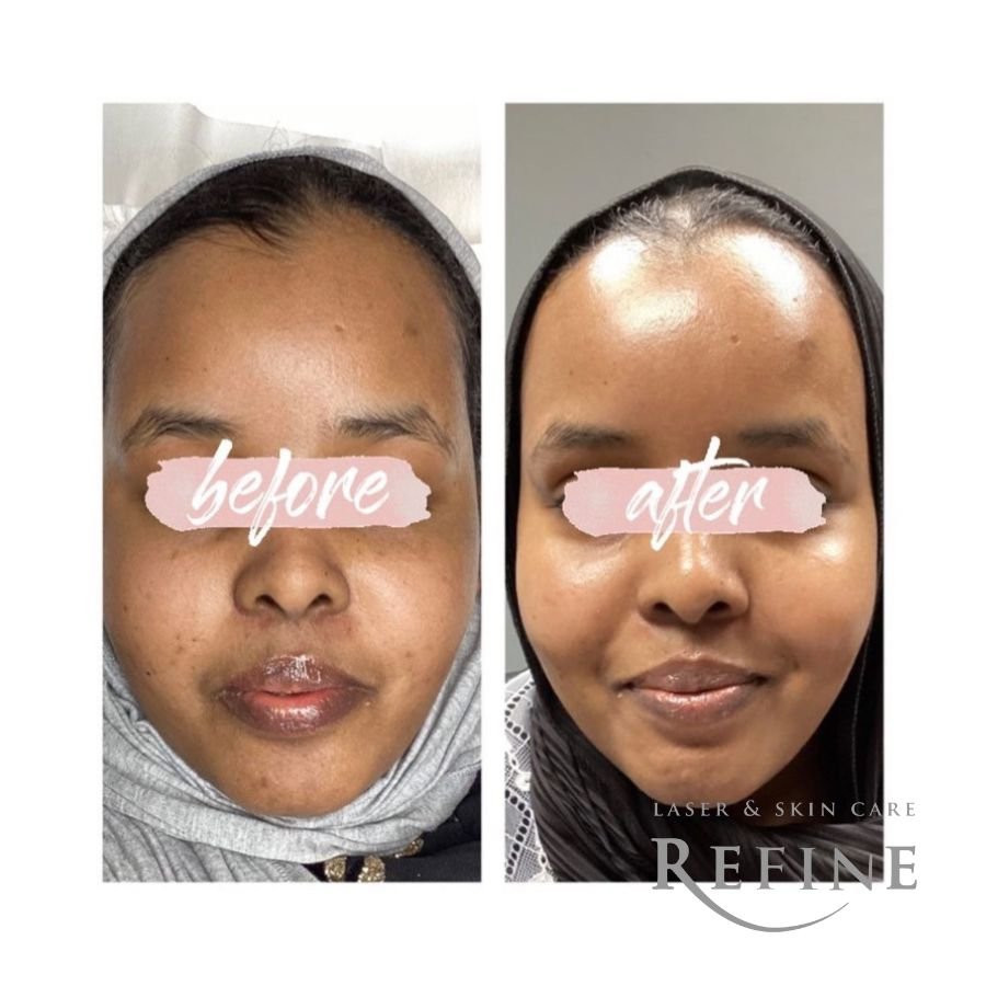 Moxi Glow (3 Treatments) 