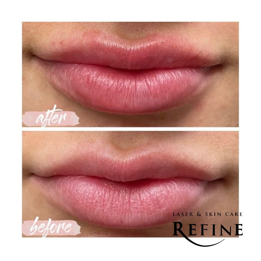 Lip Filler Revenesse Versa