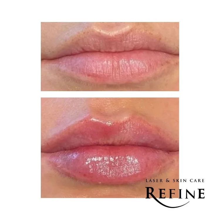 Juvéderm Ultra XC for Lips