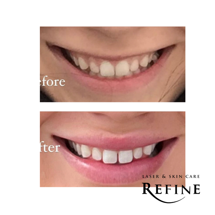 Juvederm Lip Filler + Botox Lip Flip