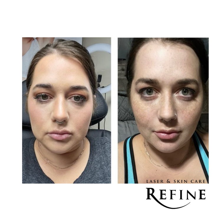 Kybella Chin Before and After Chanhassen, MN