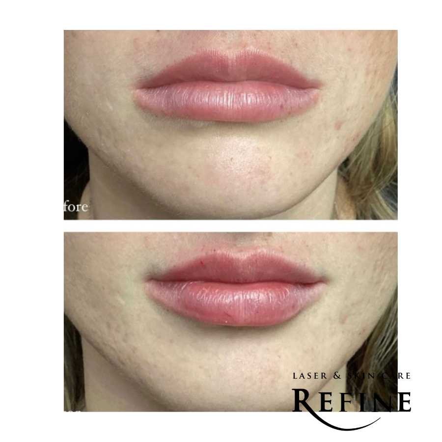 Lip Filler