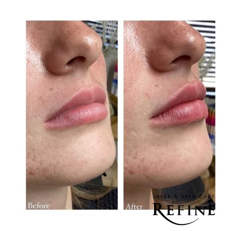 Lip Filler