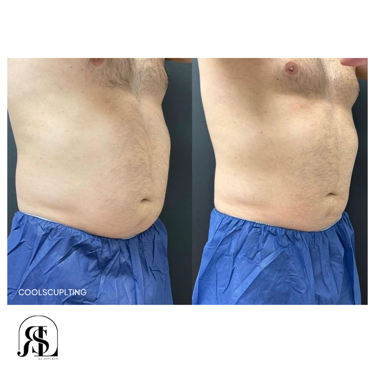 CoolSculpting before and after on the flanks in Chanhassen, MN