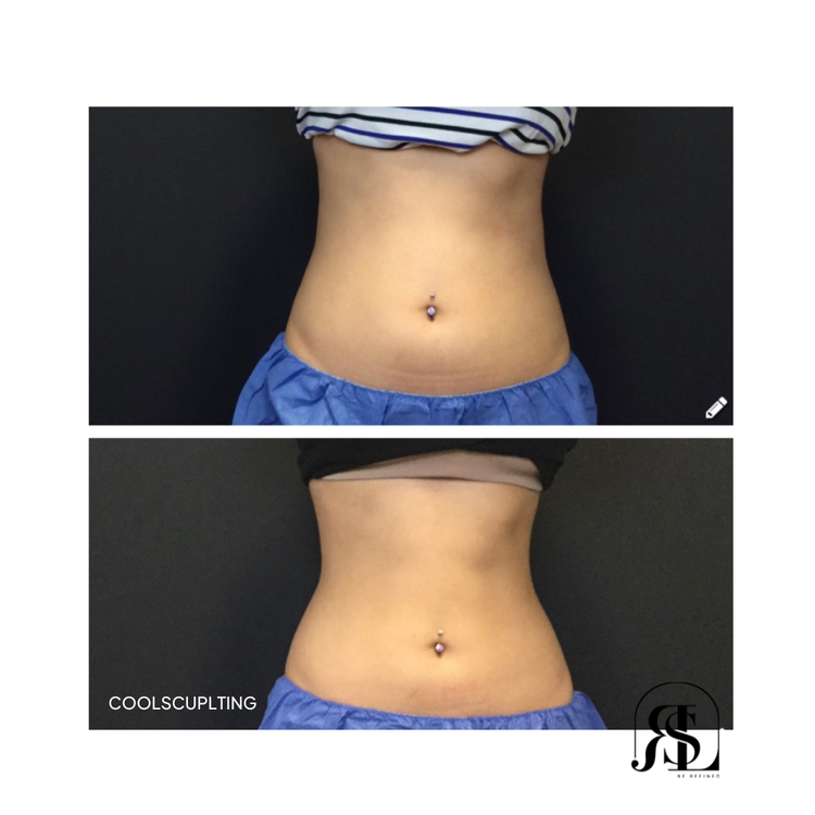 CoolSculpting before and after on the abdomen in Chanhassen, MN