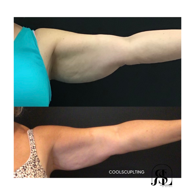 CoolSculpting before and after on the upper arms in Chanhassen, MN