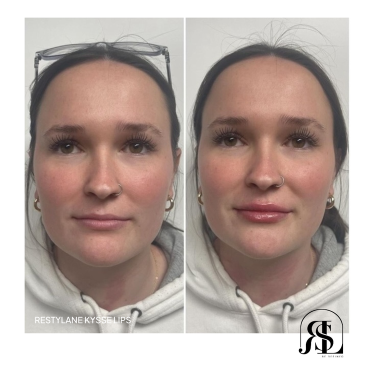 Restylane Kysse lip filler before and after in Chanhassen, MN