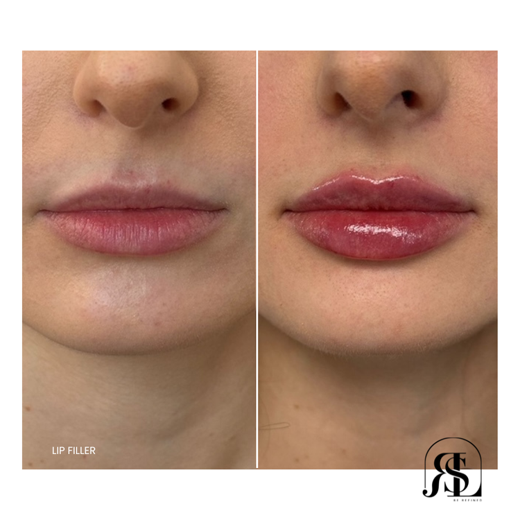 Lip Filler Before & After Chanhassen, MN