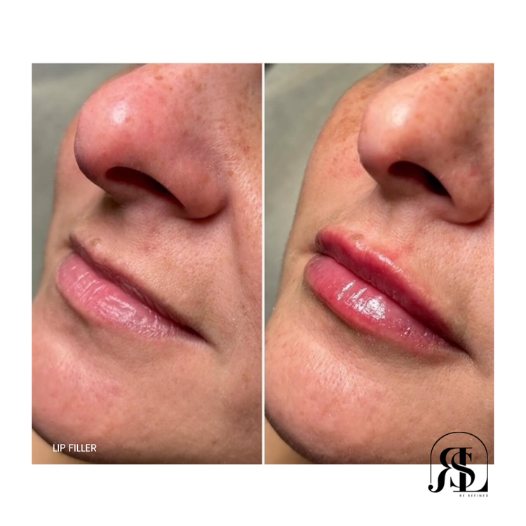 Who is the TOP Lip Injector for Fillers in Chanhassen, Minnesota?