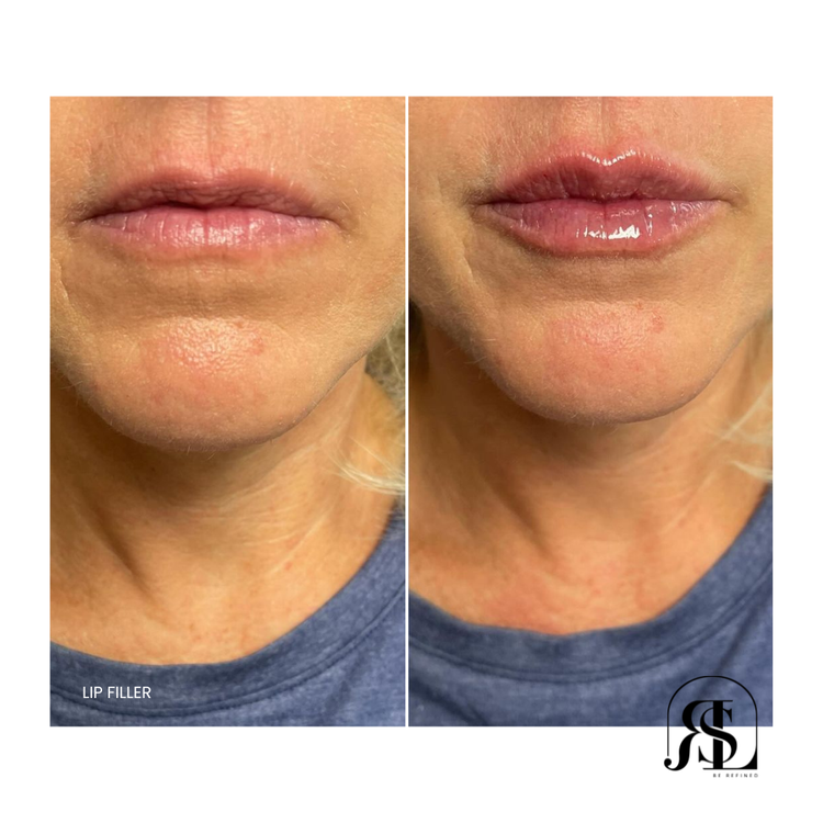 Patient Lip Enhancement and Lip Filler Results in Chanhassen, MN