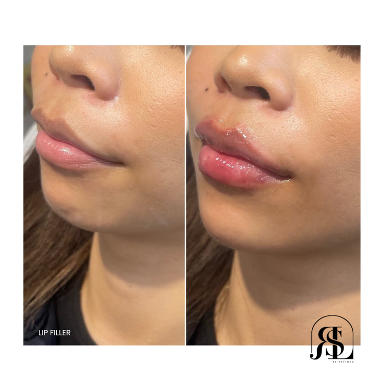 Asian Lip Filler Before and After Chanhassen, MN