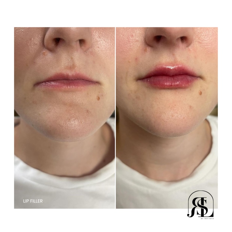 Lip filler before and after in Chanhassen, MN