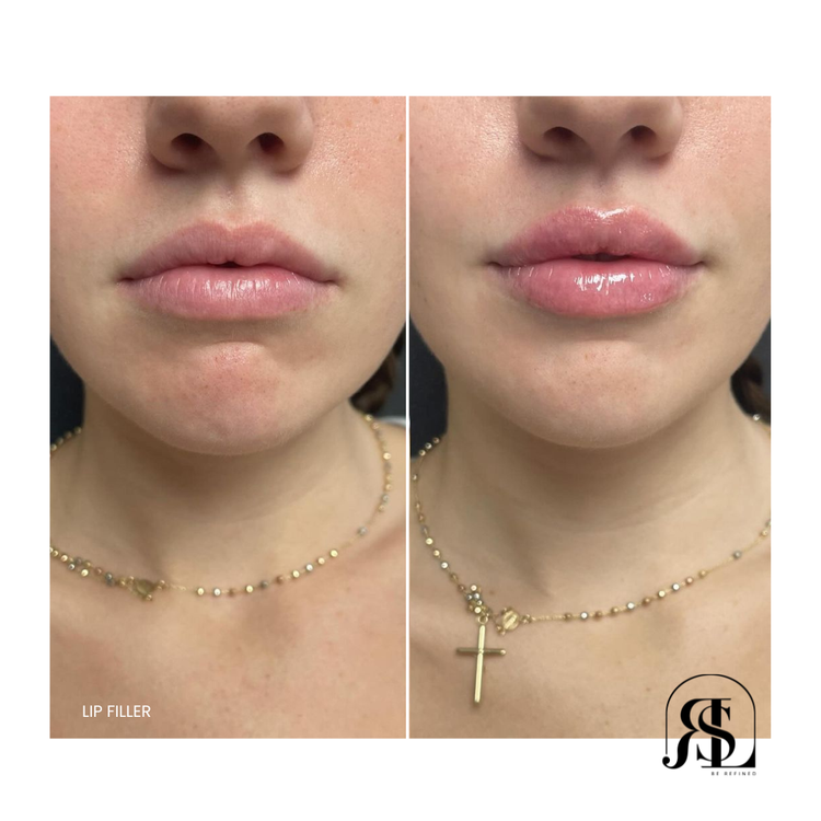 Lip filler before and after in Chanhassen, MN
