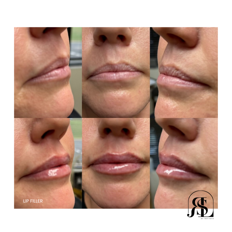 Lip filler before and after from three angles in Chanhassen, MN