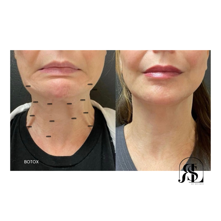 Botox for neck bands before and after in Chanhassen, MN