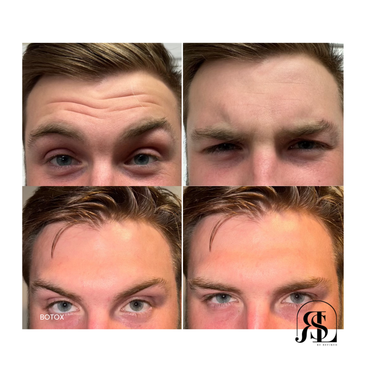 Botox for forehead lines and frown lines before and after in Chanhassen, MN