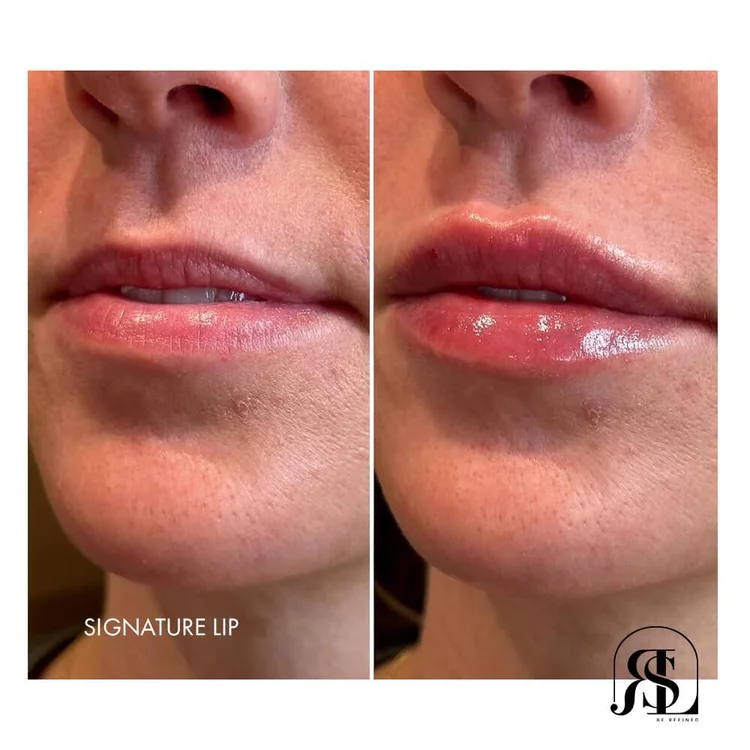 Signature Lip Filler Technique Before & After Result in Chanhassen, MN