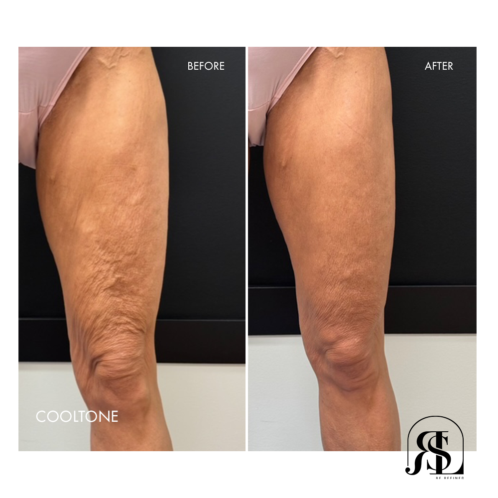 CoolTone before and after results for the legs in Chanhassen, MN. Address crepey legs with CoolTone.