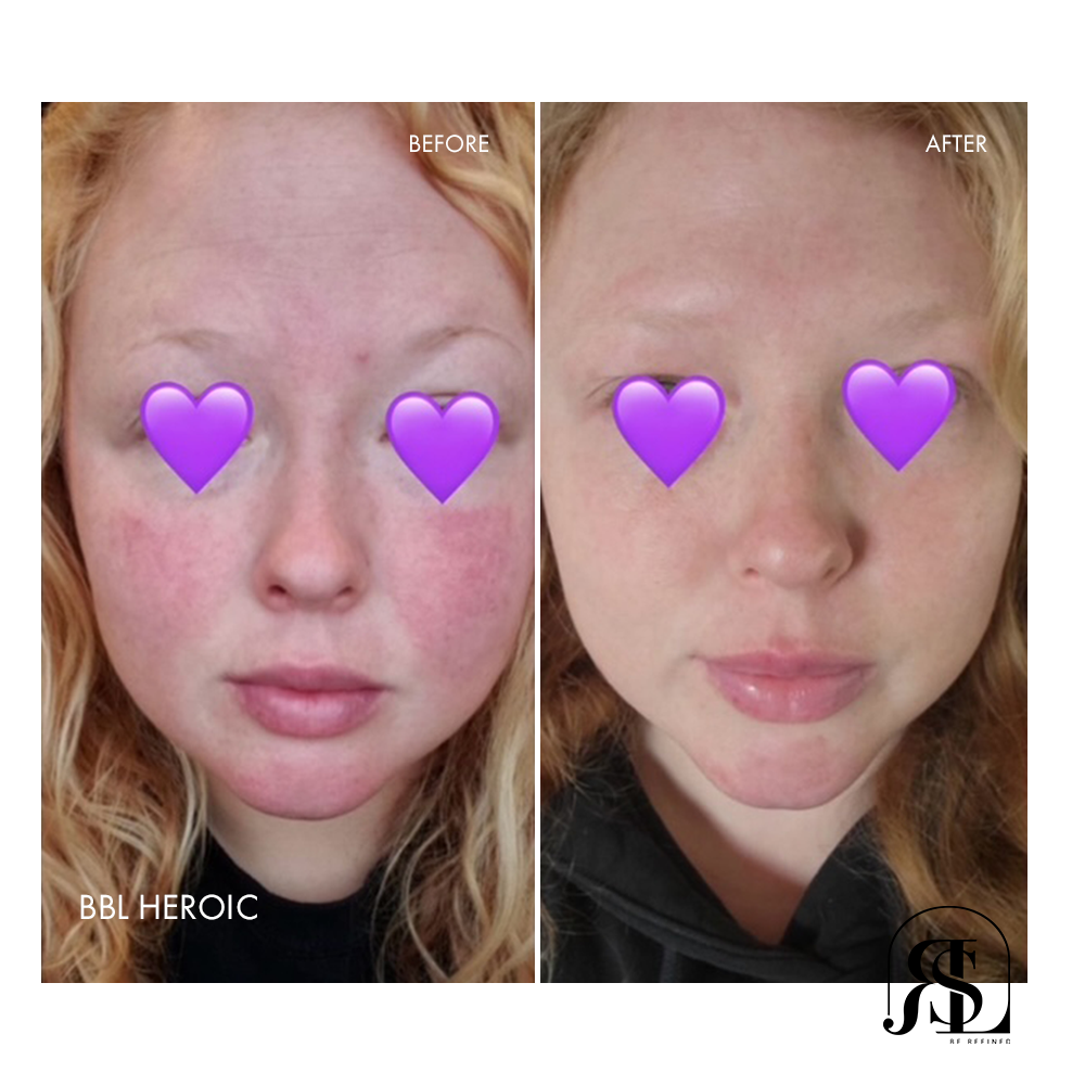 BBL HEROic laser before and after for rosacea in Chanhassen, MN.