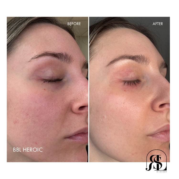 BBL HEROic laser for acne before and after results in Chanhassen, MN.