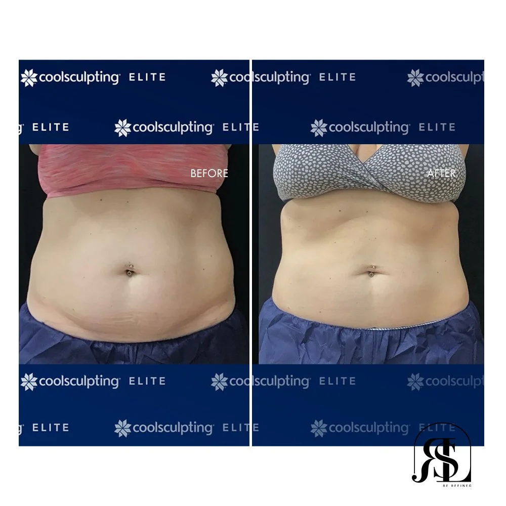 Coolsculpting Before and After to the abdomen near Chanhassen, MN.