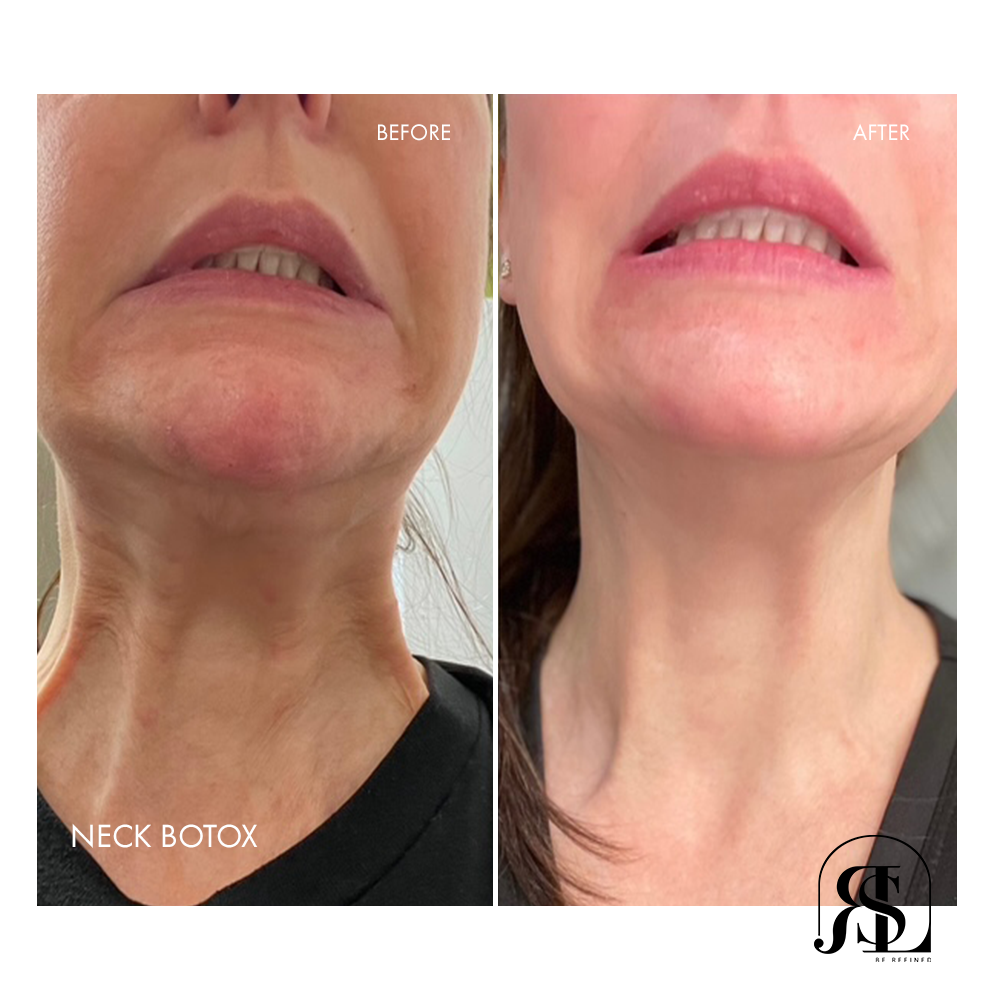 Neck Botox before and after Chanhassen, MN.