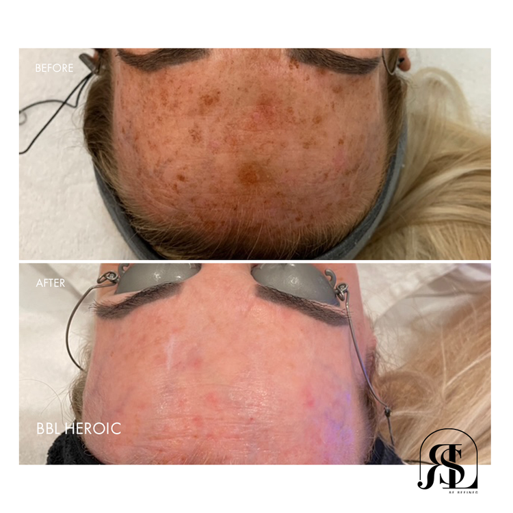 BBL HEROic before and after for melasma in Chanhassen, MN