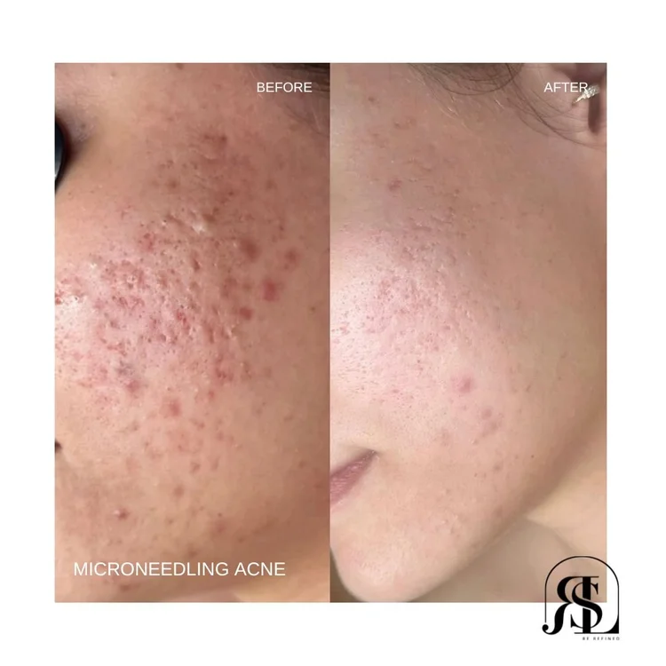 Microneedling before and after for acne in Chanhassen, MN