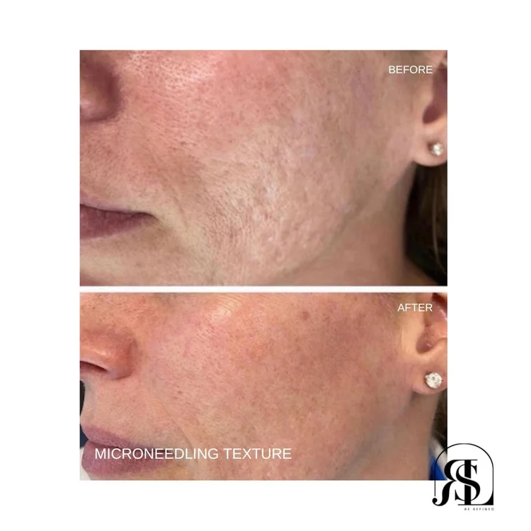 Microneedling before and after for skin texture in Chanhassen, MN