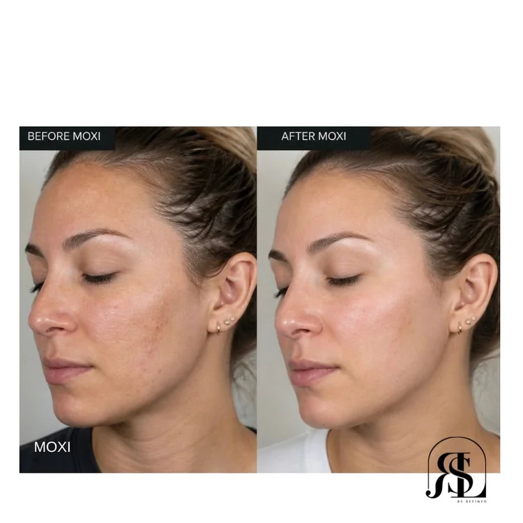 Moxi laser before and after in Chanhassen, MN