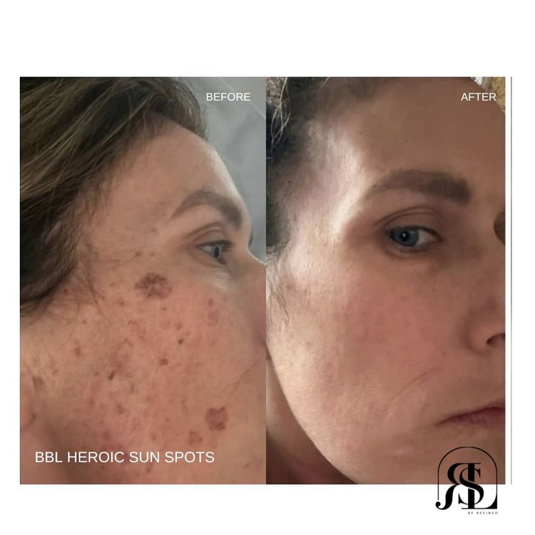 BBL HEROic before and after for sun spots in Chanhassen, MN
