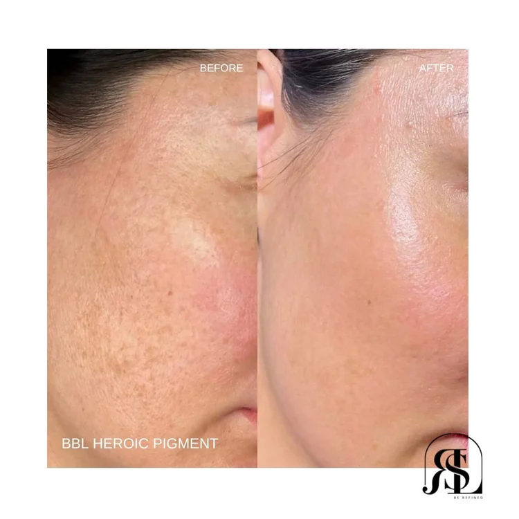 BBL HEROic before and after for pigment in Chanhassen, MN