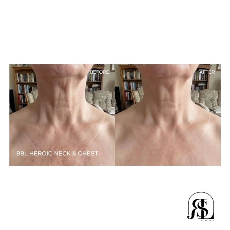 BBL HEROic before and after on the neck and chest in Chanhassen, MN