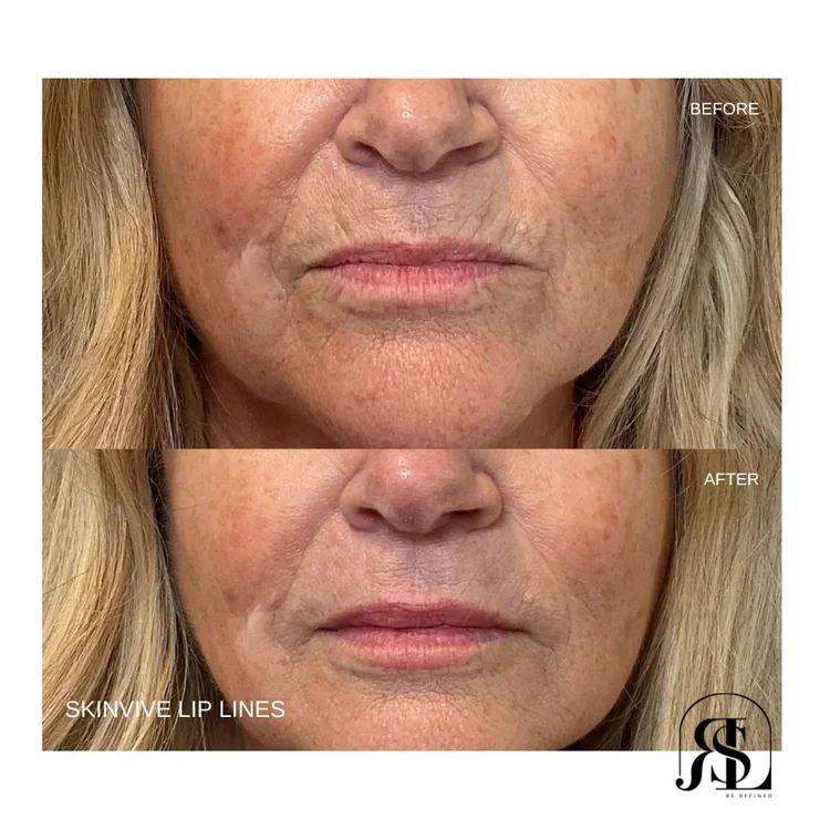 SKINVIVE before and after for lip lines in Chanhassen, MN