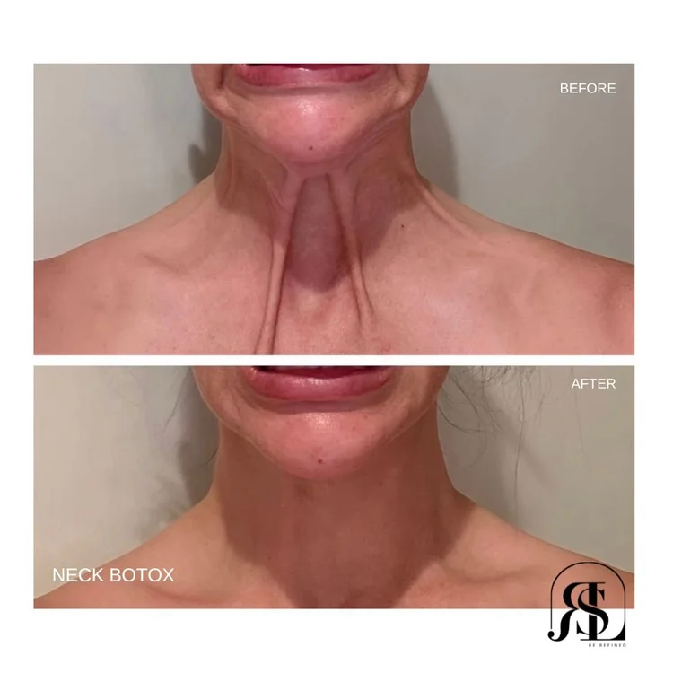Botox for neck bands before and after in Chanhassen, MN