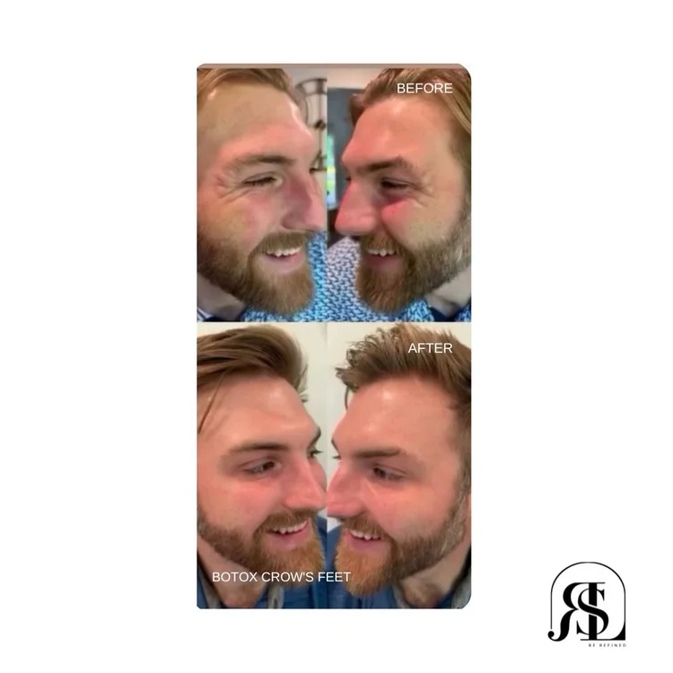 Botox for crow's feet before and after in Chanhassen, MN