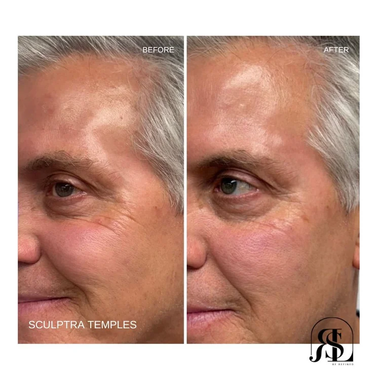 Sculptra temple filler before and after in Chanhassen, MN