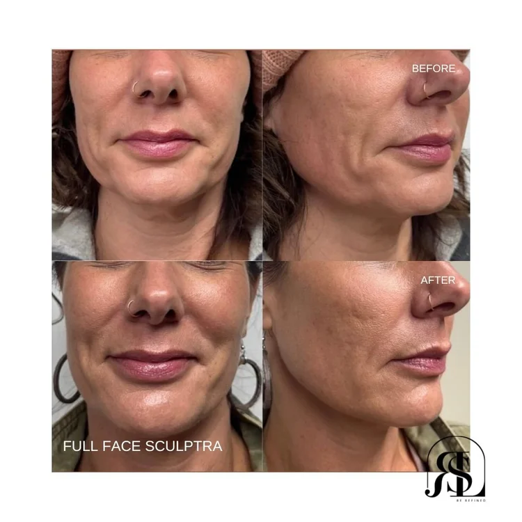 Full face Sculptra before and after in Chanhassen, MN