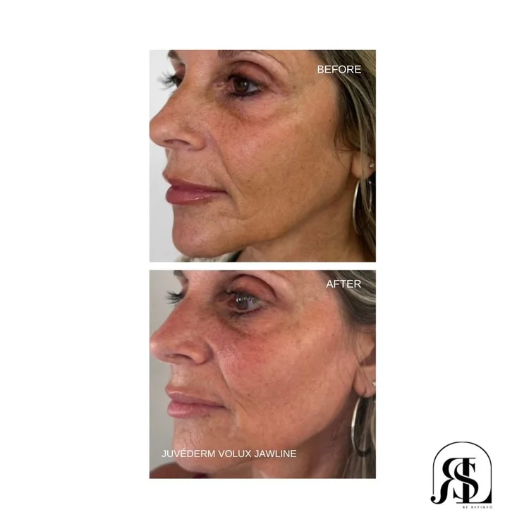 JUVÉDERM Volux jawline filler before and after in Chanhassen, MN