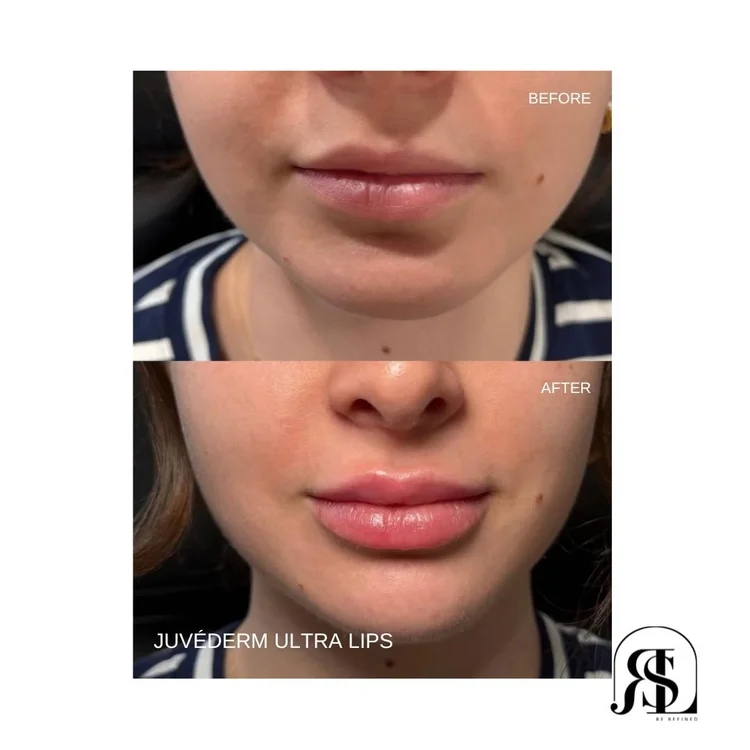 JUVÉDERM Ultra lip filler before and after in Chanhassen, MN