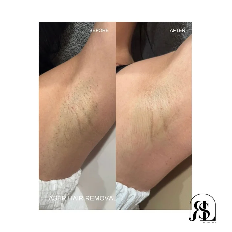 Laser hair removal before and after on the underarm at Refine Laser & Skin Care in Chanhassen, MN