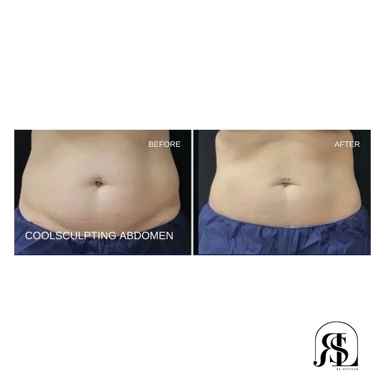CoolSculpting abdomen before and after in Chanhassen, MN