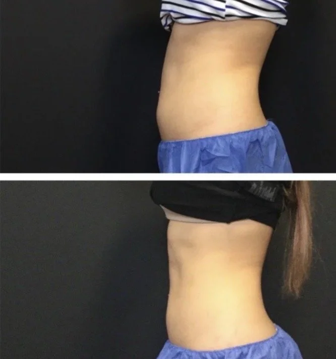 coolsculpting-before-and-after